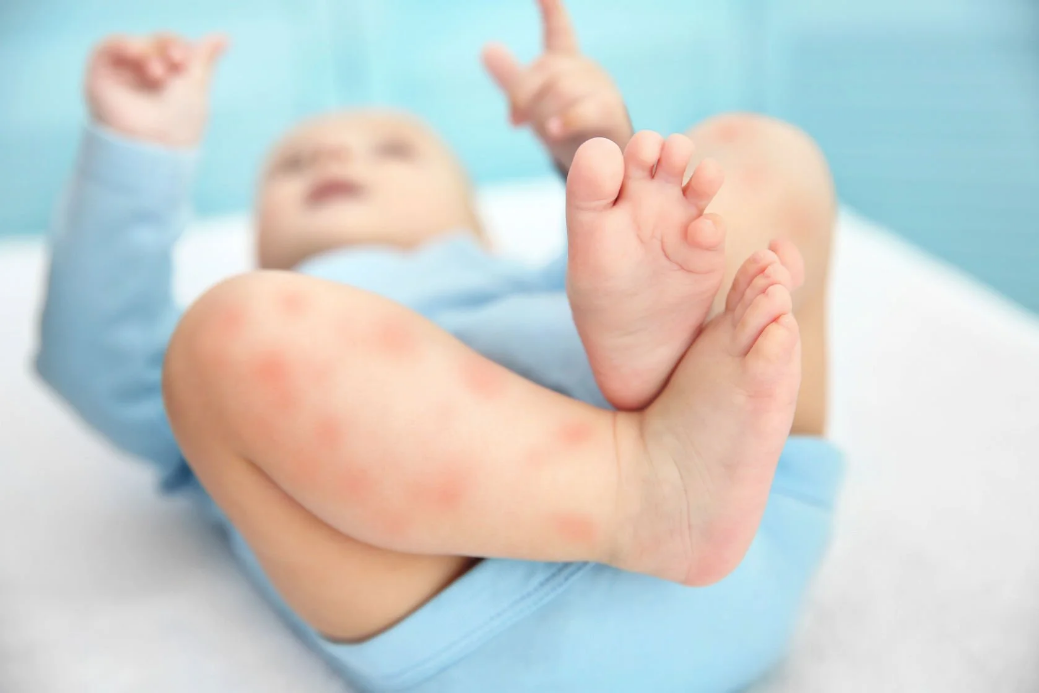 Cara Mencegah Alergi Susu Sapi Pada Anak